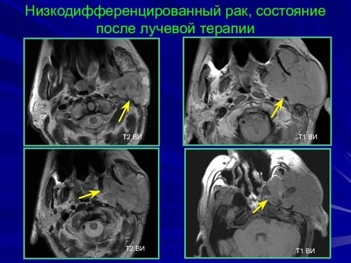 Низкодифференцированный рак, состояние после лучевой терапии T2 BИ T2 BИ T1 BИ T1 BИ