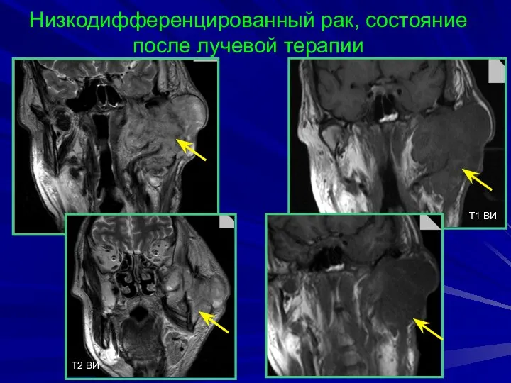 Низкодифференцированный рак, состояние после лучевой терапии T2 BИ T1 BИ