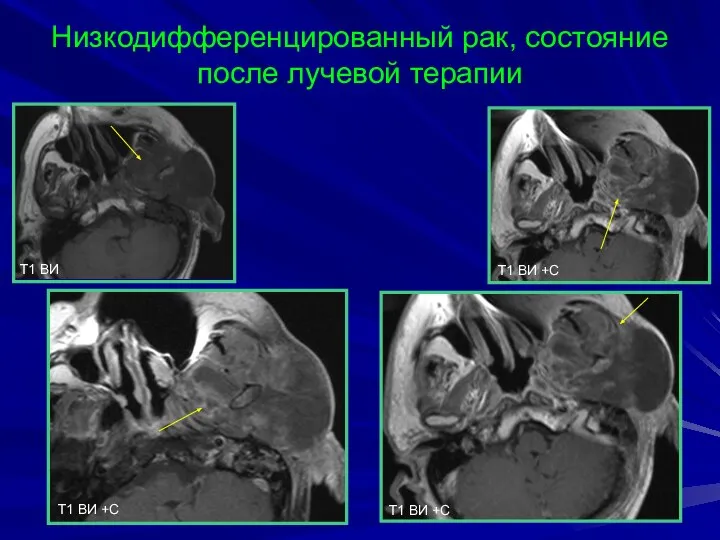 Низкодифференцированный рак, состояние после лучевой терапии T1 BИ T1 BИ +С