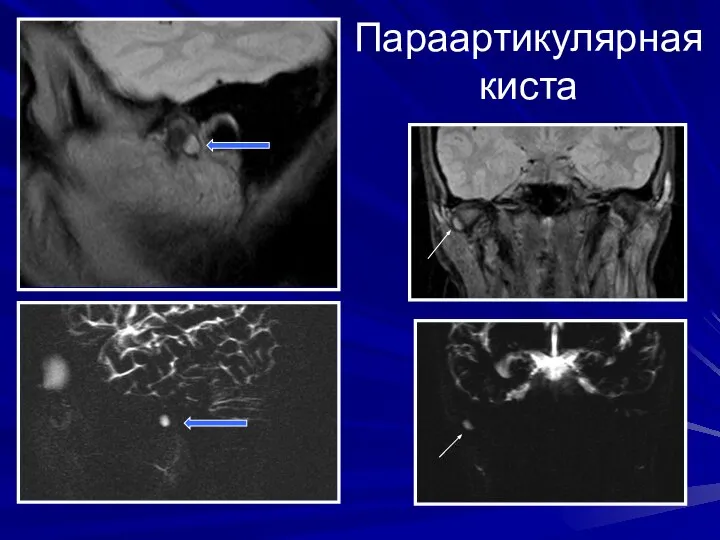 Параартикулярная киста