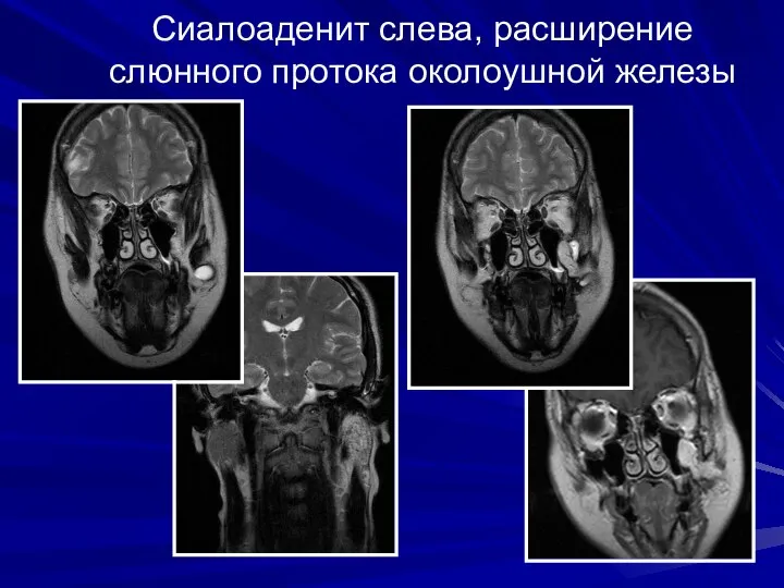 Сиалоаденит слева, расширение слюнного протока околоушной железы