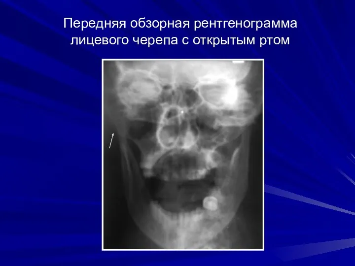 Передняя обзорная рентгенограмма лицевого черепа с открытым ртом