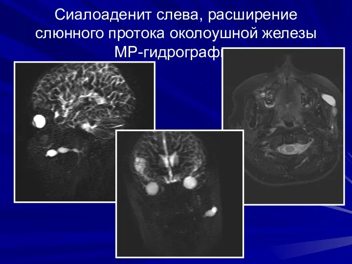 Сиалоаденит слева, расширение слюнного протока околоушной железы МР-гидрография