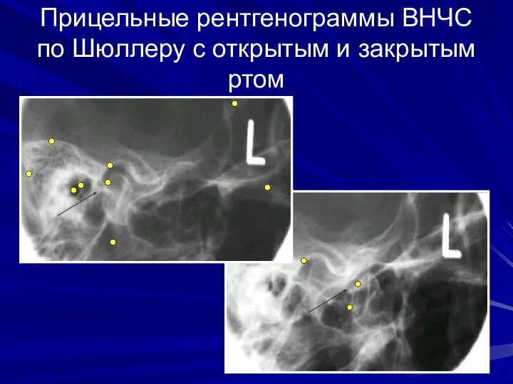 Прицельные рентгенограммы ВНЧС по Шюллеру с открытым и закрытым ртом