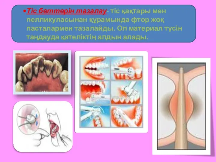 Тіс беттерін тазалау- тіс қақтары мен пелликуласынан құрамында фтор жоқ пасталармен
