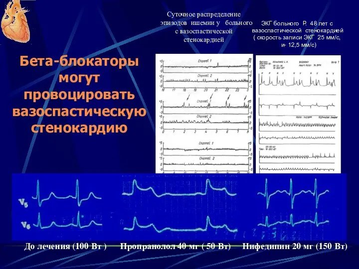 ЭКГ больного Р. 48 лет с вазоспастической стенокардией ( скорость записи