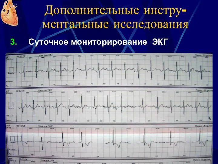 Дополнительные инстру-ментальные исследования Суточное мониторирование ЭКГ