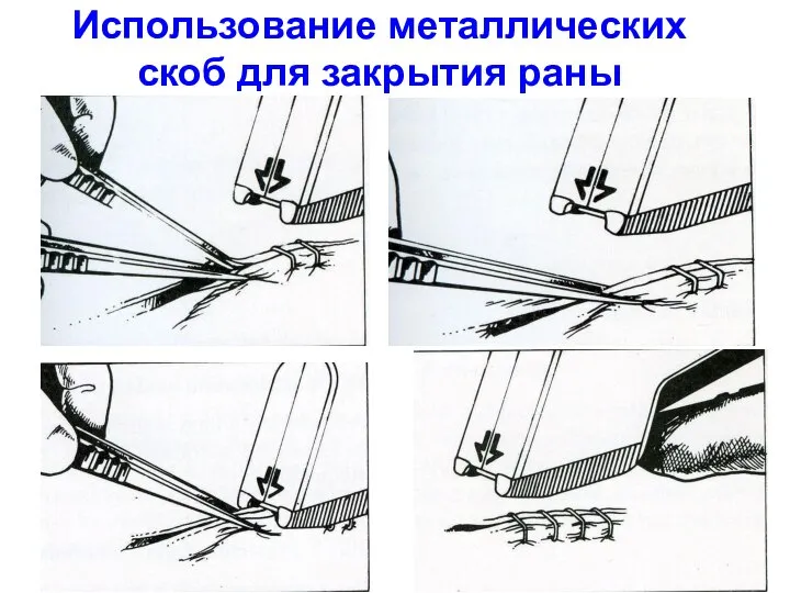 Использование металлических скоб для закрытия раны