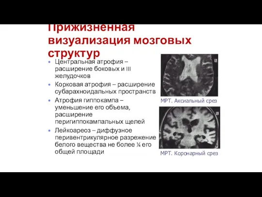 Прижизненная визуализация мозговых структур Центральная атрофия – расширение боковых и III