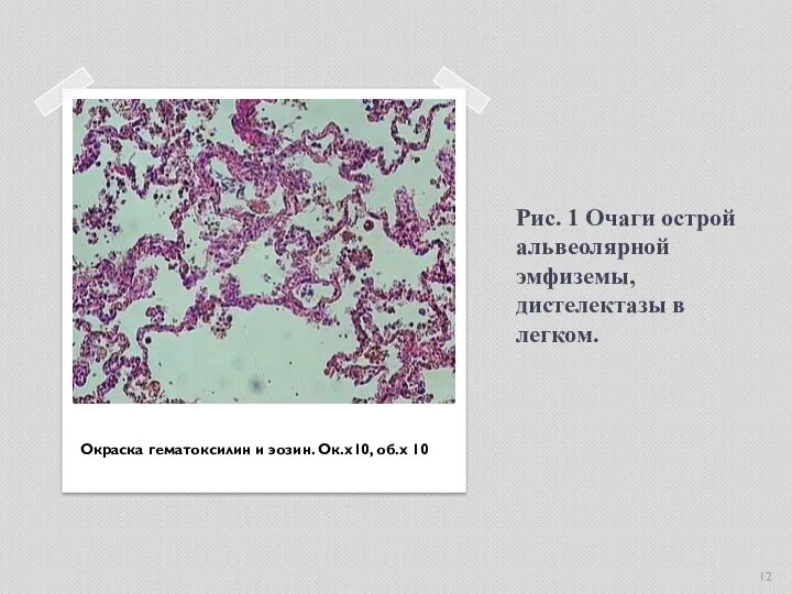 Рис. 1 Очаги острой альвеолярной эмфиземы, дистелектазы в легком. Окраска гематоксилин и эозин. Ок.х10, об.х 10