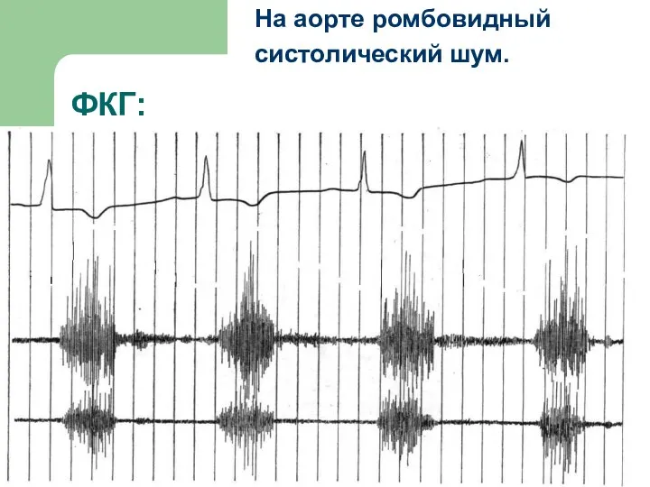 ФКГ: На аорте ромбовидный систолический шум.