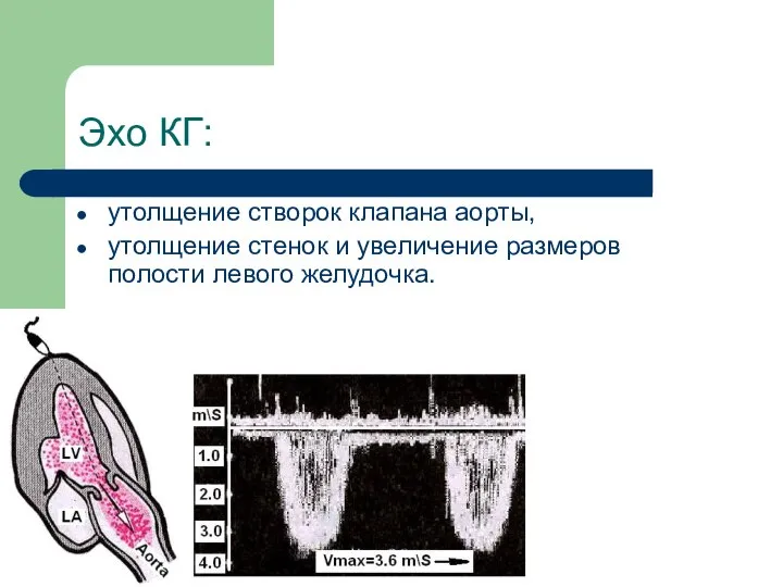 Эхо КГ: утолщение створок клапана аорты, утолщение стенок и увеличение размеров полости левого желудочка.