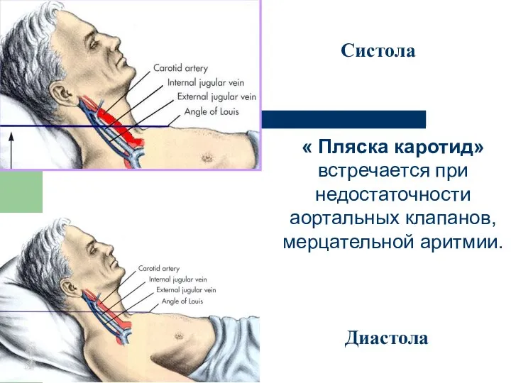 « Пляска каротид» встречается при недостаточности аортальных клапанов, мерцательной аритмии. Систола Диастола