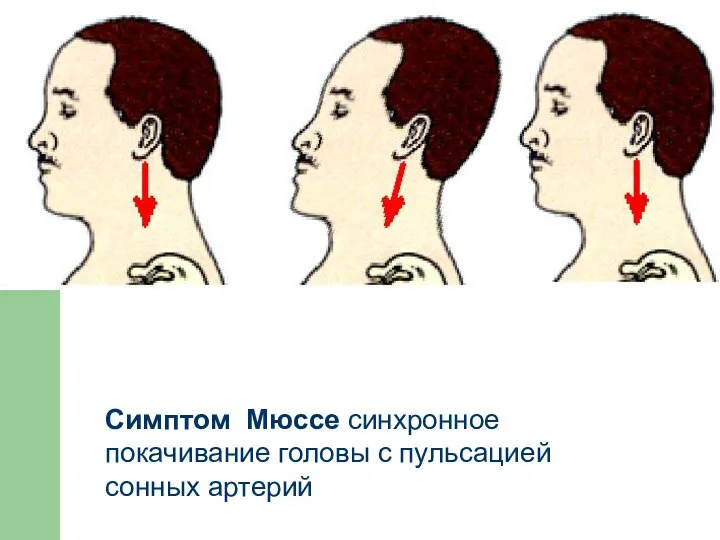 Симптом Мюссе синхронное покачивание головы с пульсацией сонных артерий