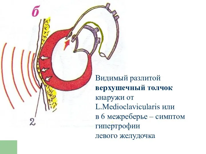 Видимый разлитой верхушечный толчок кнаружи от L.Medioclavicularis или в 6 межреберье – симптом гипертрофии левого желудочка