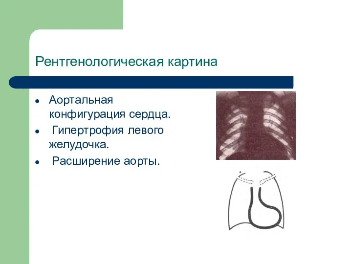 Рентгенологическая картина Аортальная конфигурация сердца. Гипертрофия левого желудочка. Расширение аорты.