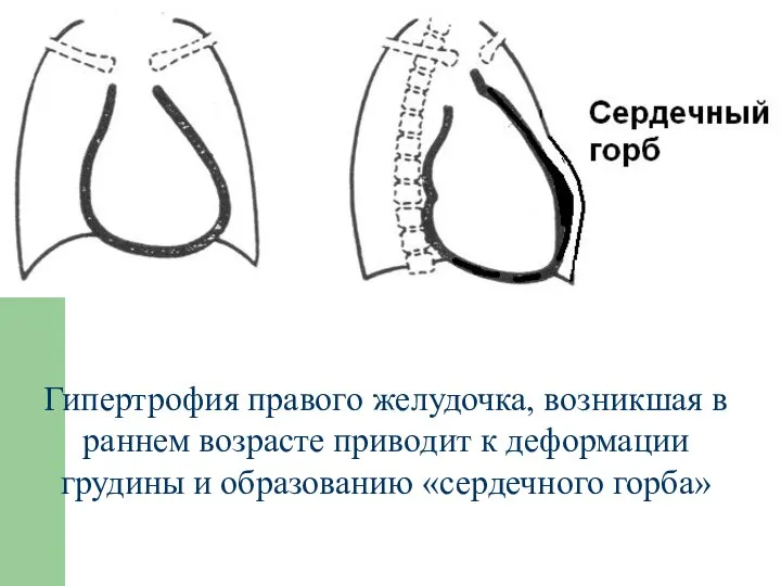 Гипертрофия правого желудочка, возникшая в раннем возрасте приводит к деформации грудины и образованию «сердечного горба»