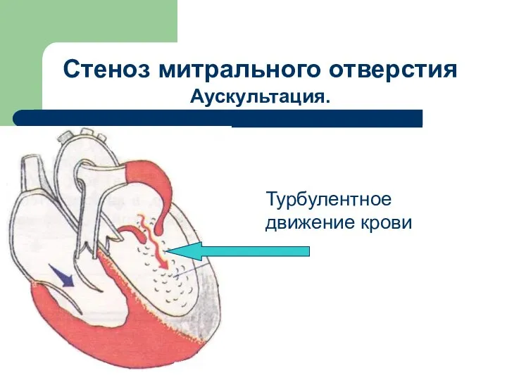 Стеноз митрального отверстия Аускультация. Турбулентное движение крови