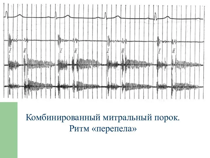 Комбинированный митральный порок. Ритм «перепела»