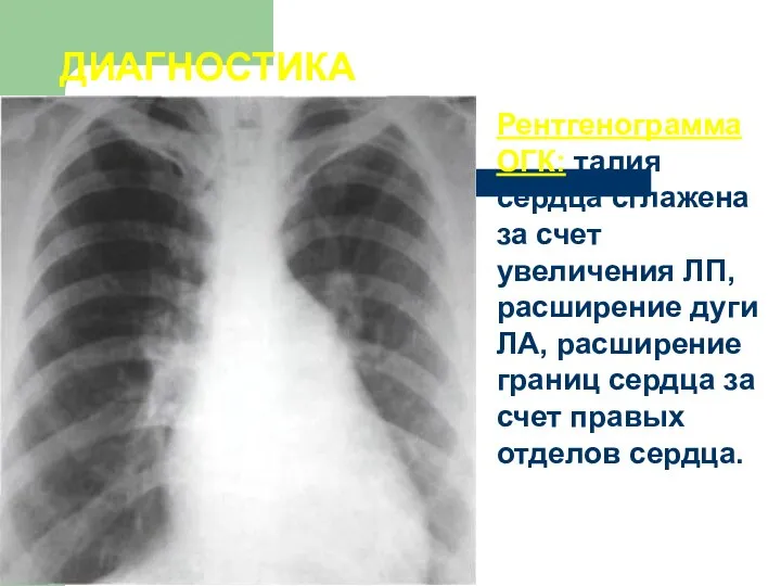 Рентгенограмма ОГК: талия сердца сглажена за счет увеличения ЛП, расширение дуги