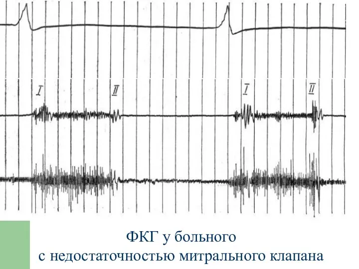 ФКГ у больного с недостаточностью митрального клапана