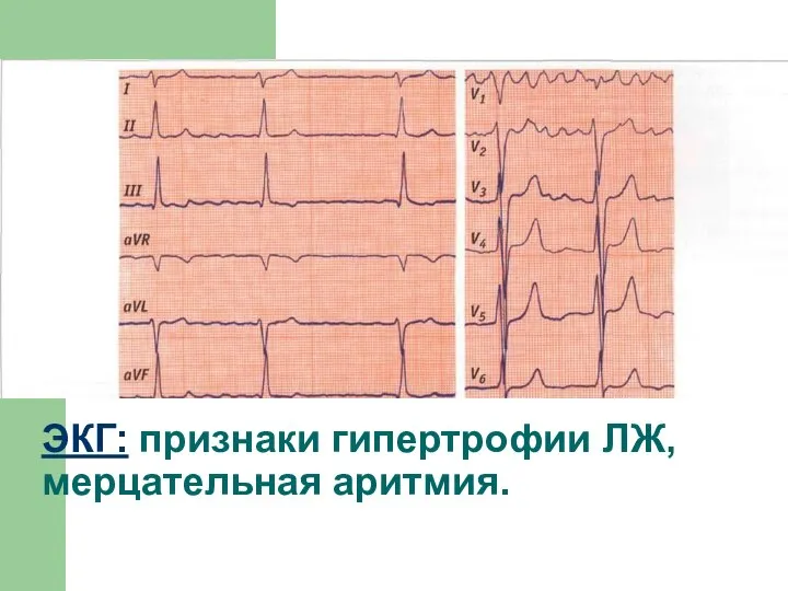 ЭКГ: признаки гипертрофии ЛЖ, мерцательная аритмия.