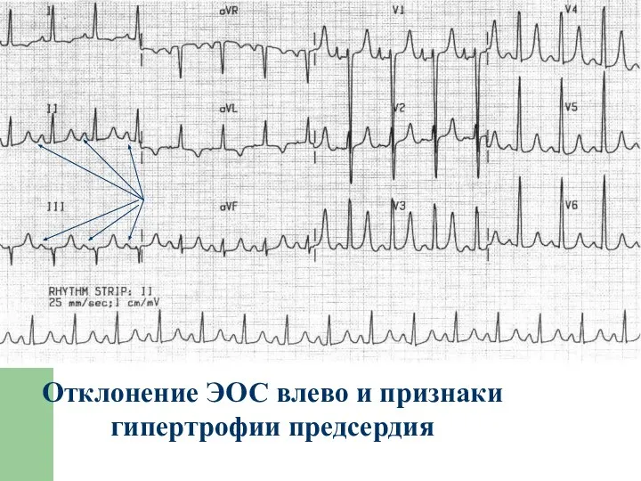 Отклонение ЭОС влево и признаки гипертрофии предсердия