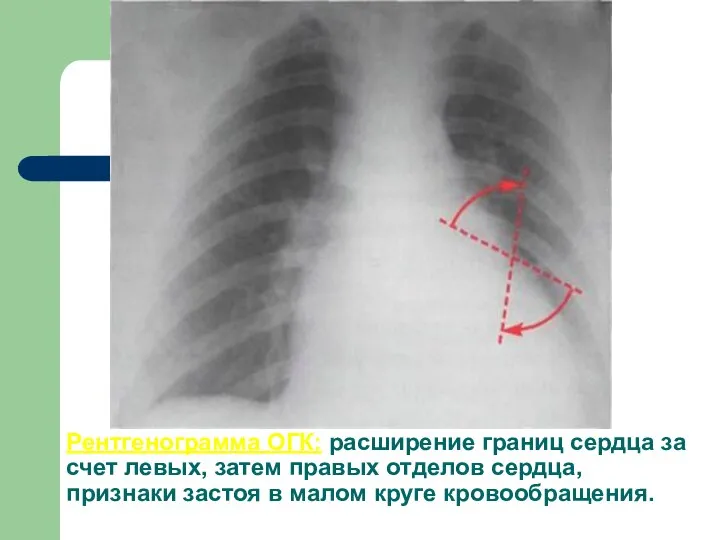 Рентгенограмма ОГК: расширение границ сердца за счет левых, затем правых отделов