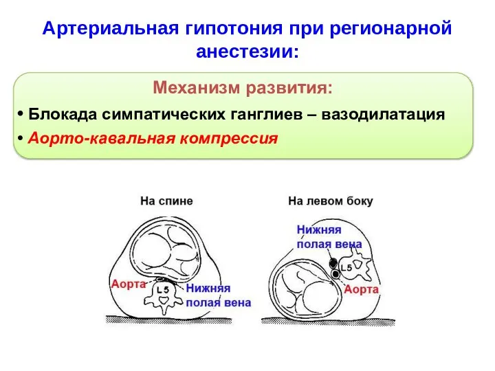 Артериальная гипотония при регионарной анестезии: Механизм развития: Блокада симпатических ганглиев – вазодилатация Аорто-кавальная компрессия