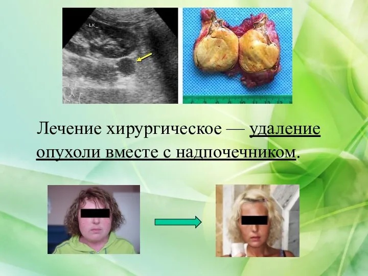 Лечение хирургическое — удаление опухоли вместе с надпочечником.