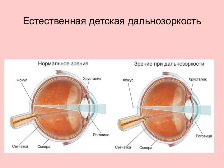 Естественная детская дальнозоркость