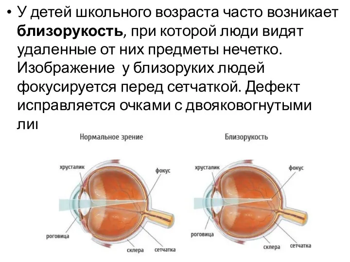 У детей школьного возраста часто возникает близорукость, при которой люди видят