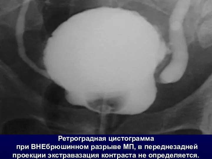 Ретроградная цистограмма при ВНЕбрюшинном разрыве МП, в переднезадней проекции экстравазация контраста не определяется.