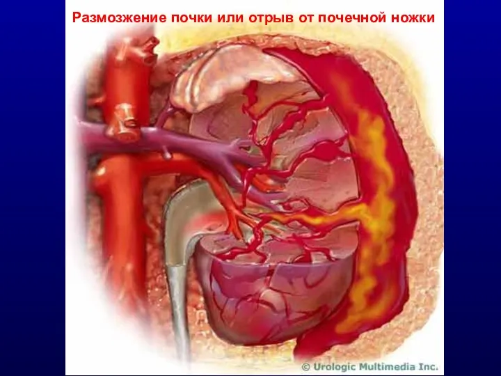 Размозжение почки или отрыв от почечной ножки