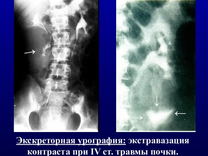 ↑ ↑ ↑ Экскреторная урография: экстравазация контраста при IV ст. травмы почки. ↑