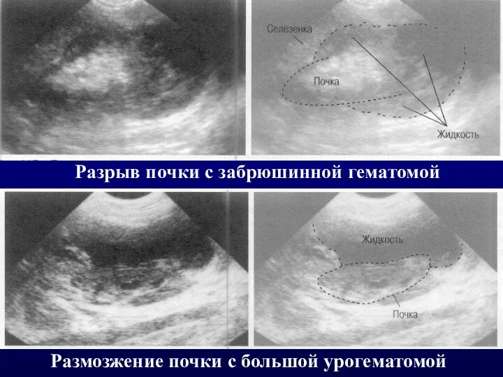 Разрыв почки с забрюшинной гематомой Размозжение почки с большой урогематомой