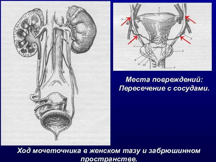 Ход мочеточника в женском тазу и забрюшинном пространстве. Места повреждений: Пересечение