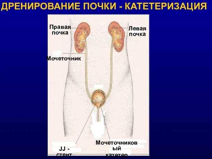 ДРЕНИРОВАНИЕ ПОЧКИ - КАТЕТЕРИЗАЦИЯ