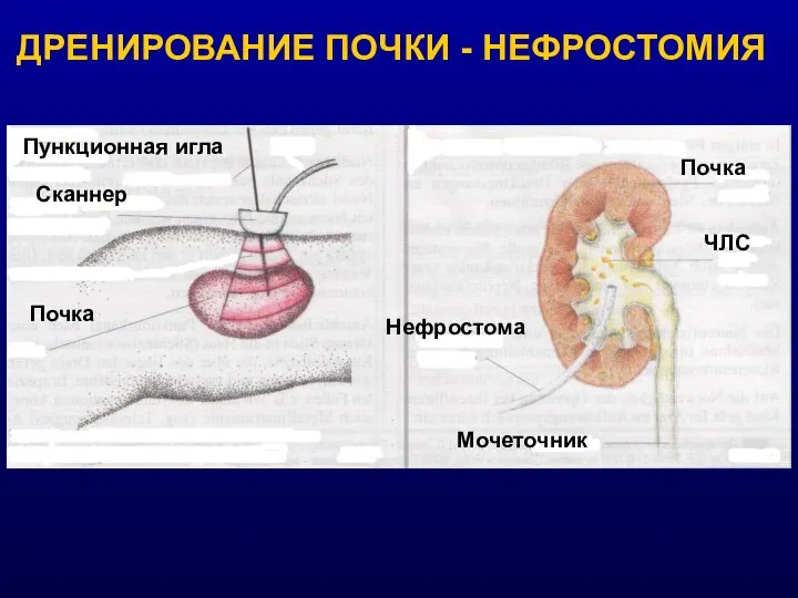 ДРЕНИРОВАНИЕ ПОЧКИ - НЕФРОСТОМИЯ Пункционная игла Сканнер Почка ЧЛС Мочеточник Нефростома Почка