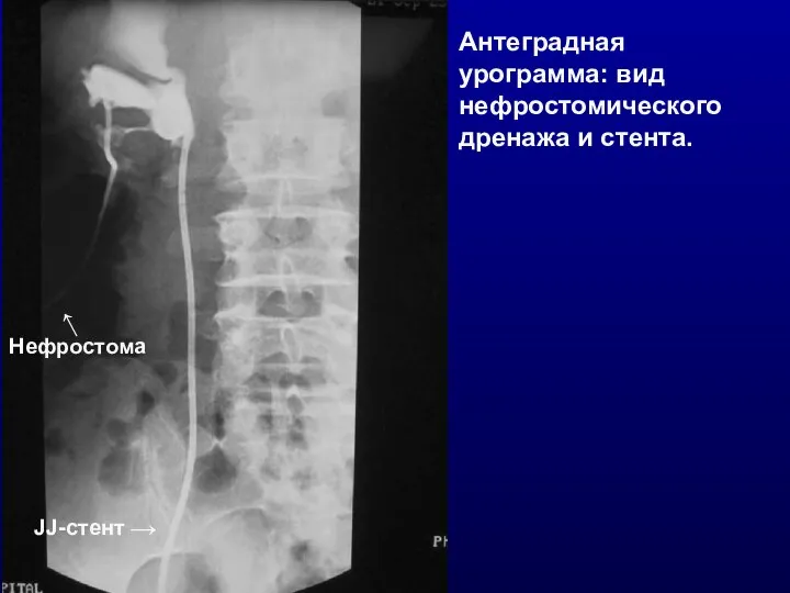 Антеградная урограмма: вид нефростомического дренажа и стента.