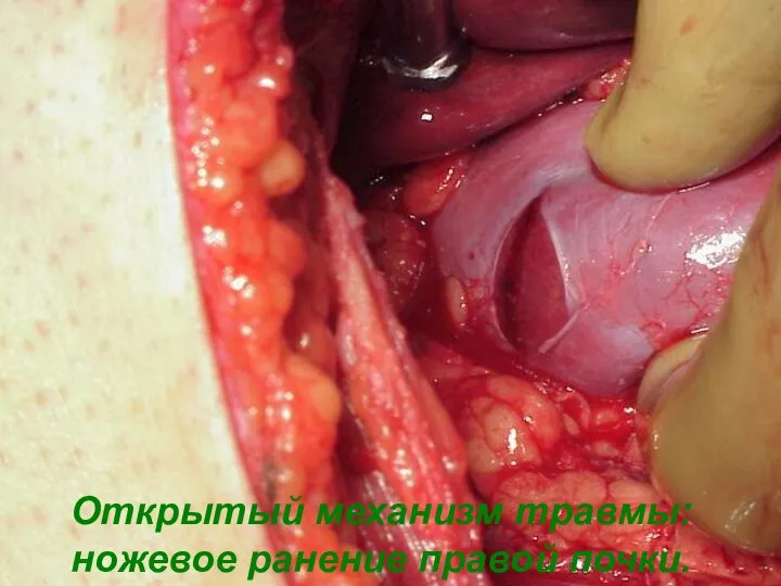 Открытый механизм травмы: ножевое ранение правой почки.