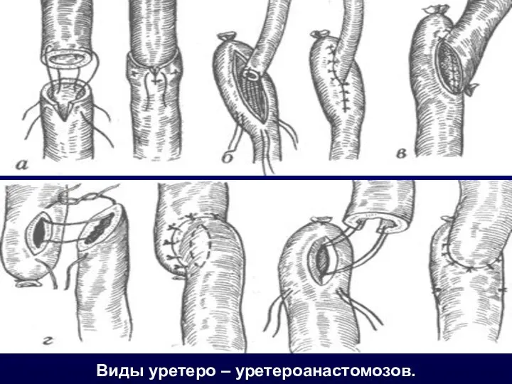 Виды уретеро – уретероанастомозов.