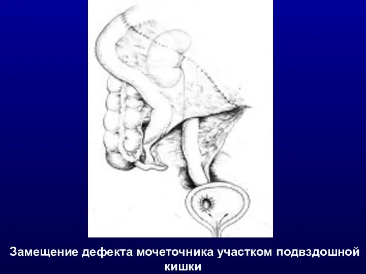 Замещение дефекта мочеточника участком подвздошной кишки