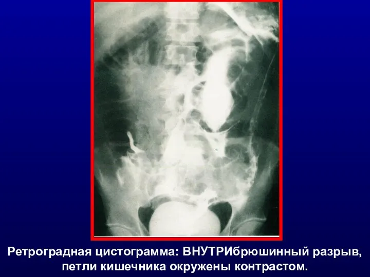 Ретроградная цистограмма: ВНУТРИбрюшинный разрыв, петли кишечника окружены контрастом.