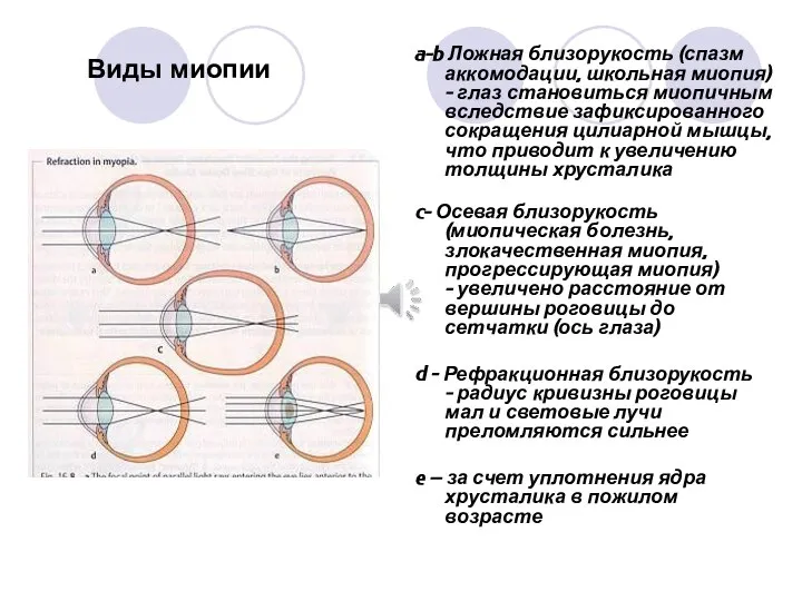 a-b Ложная близорукость (спазм аккомодации, школьная миопия) - глаз становиться миопичным