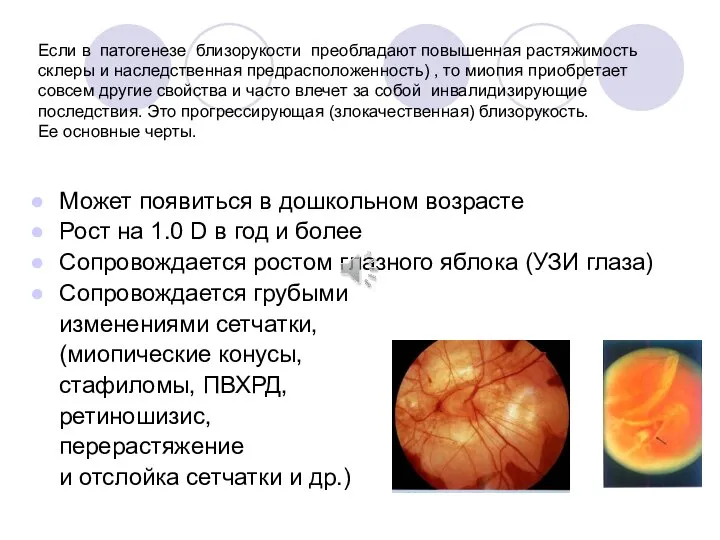 Если в патогенезе близорукости преобладают повышенная растяжимость склеры и наследственная предрасположенность)