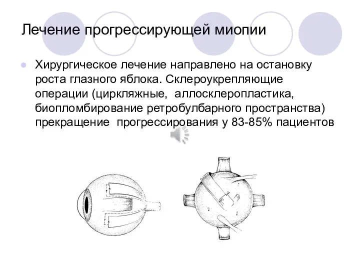 Лечение прогрессирующей миопии Хирургическое лечение направлено на остановку роста глазного яблока.