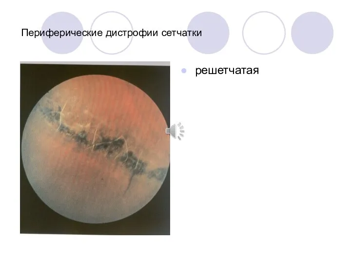 Периферические дистрофии сетчатки решетчатая