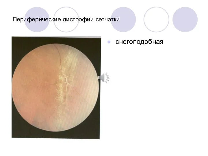 Периферические дистрофии сетчатки снегоподобная