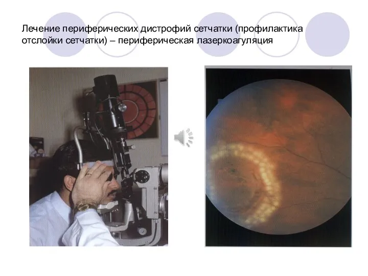 Лечение периферических дистрофий сетчатки (профилактика отслойки сетчатки) – периферическая лазеркоагуляция